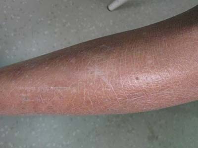 轻度鱼鳞病的症状