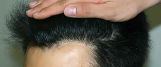 ���ݱ���Ƥ��ר��ҽԺŮ�Ե��˸������ѷ���ô��