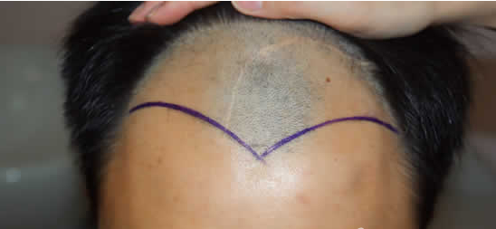 ���ݱ���Ƥ��ר��ҽԺ��ε����ѷ�����֢״