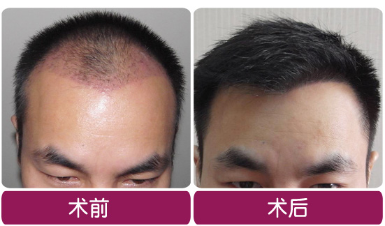 ���ݱ���Ƥ��ר��ҽԺֲ��������ʲôЧ����?