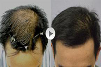 ���ݱ���Ƥ��ר��ҽԺ�����ѷ�Ӧ��ע����Щ