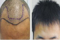 ���ݱ���Ƥ��ר��ҽԺ���Ը����Ԥ���ѷ�