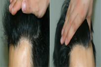 ���ݱ���Ƥ��ר��ҽԺ�̺�ֲ���ɹ��ʸ���