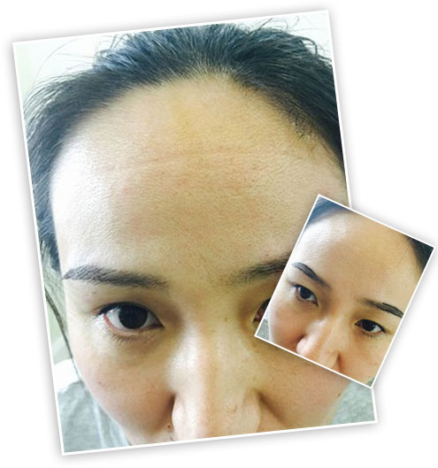 ���ݱ���Ƥ��ר��ҽԺ�ѷ�Ԥ��Ӧ��ע����Щ���棿