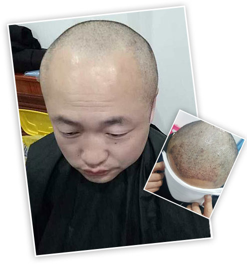 ���ݱ���Ƥ��ר��ҽԺ��ë��ֲ�ò��ã�