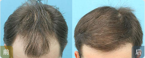 ���ݱ���Ƥ��ר��ҽԺ��ëë����ֲЧ���ò��ã�