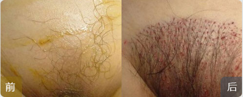 ���ݱ���Ƥ��ר��ҽԺ��������ôԤ���ѷ�