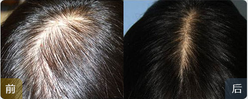 ���ݱ���Ƥ��ר��ҽԺ��ͷǰ������ͷ��������ô�죿