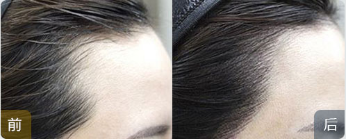 ���ݱ���Ƥ��ר��ҽԺ��ͷ�������ֲ���˼���